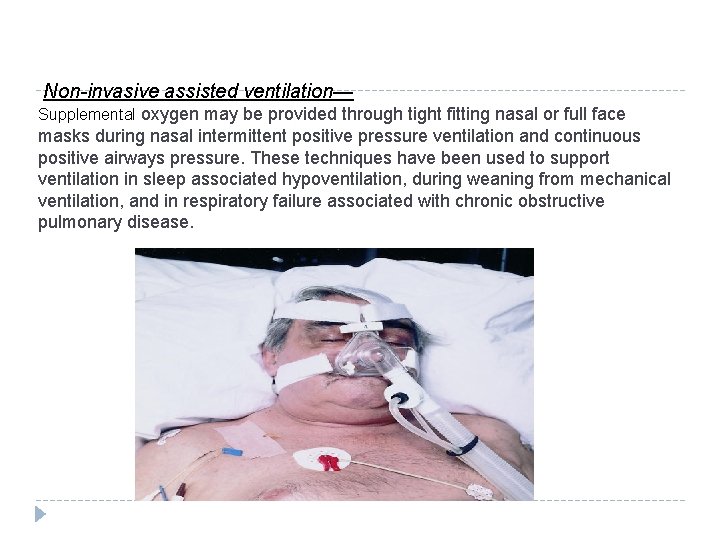 Non-invasive assisted ventilation— Supplemental oxygen may be provided through tight fitting nasal or full Non-invasive assisted ventilation— Supplemental oxygen may be provided through tight fitting nasal or full
