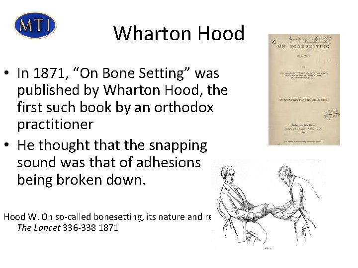 Wharton Hood • In 1871, “On Bone Setting” was published by Wharton Hood, the Wharton Hood • In 1871, “On Bone Setting” was published by Wharton Hood, the