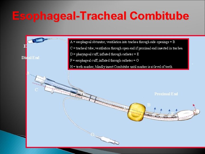 Esophageal-Tracheal Combitube A = esophageal obturator; ventilation into trachea through side openings = B Esophageal-Tracheal Combitube A = esophageal obturator; ventilation into trachea through side openings = B