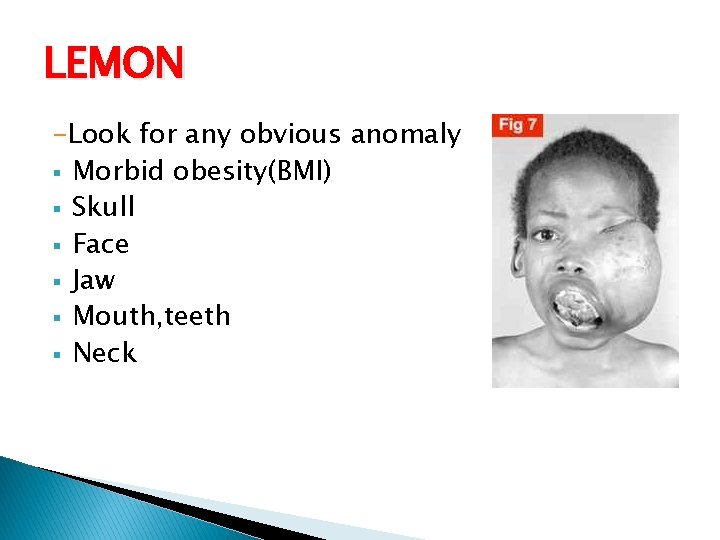 LEMON -Look for any obvious anomaly § Morbid obesity(BMI) § Skull § Face § LEMON -Look for any obvious anomaly § Morbid obesity(BMI) § Skull § Face §
