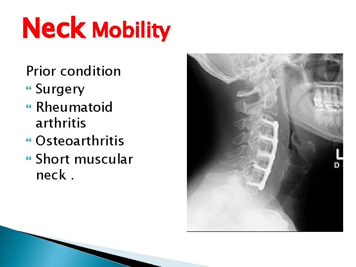 Neck Mobility Prior condition Surgery Rheumatoid arthritis Osteoarthritis Short muscular neck. Neck Mobility Prior condition Surgery Rheumatoid arthritis Osteoarthritis Short muscular neck.