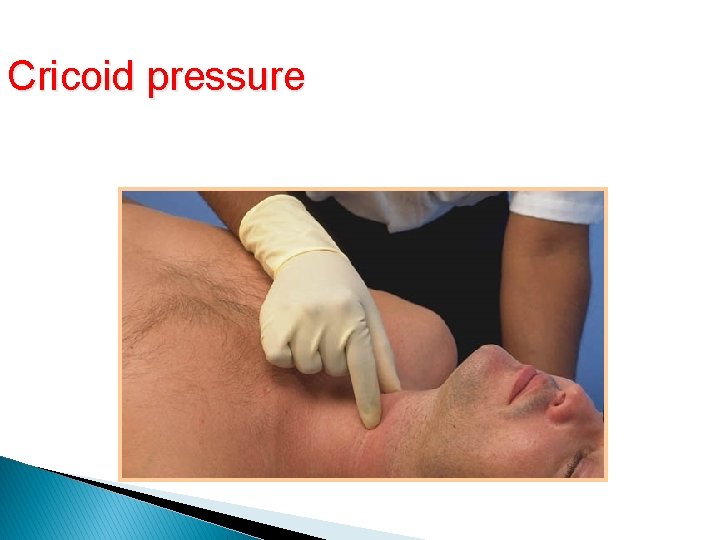 Cricoid pressure Cricoid Pressure Cricoid pressure Cricoid Pressure
