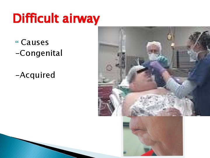 Difficult airway Causes -Congenital -Acquired Difficult airway Causes -Congenital -Acquired