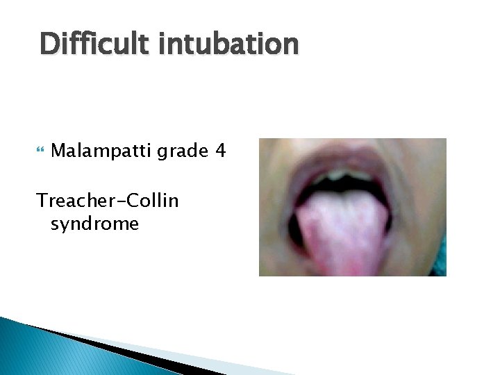 Difficult intubation Malampatti grade 4 Treacher-Collin syndrome Difficult intubation Malampatti grade 4 Treacher-Collin syndrome