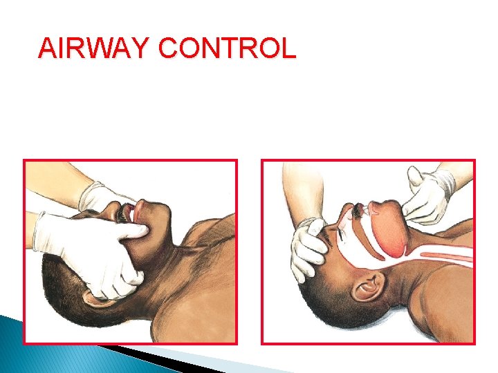 AIRWAY CONTROL Opening the Airway Jaw thrust Head tilt–chin lift AIRWAY CONTROL Opening the Airway Jaw thrust Head tilt–chin lift