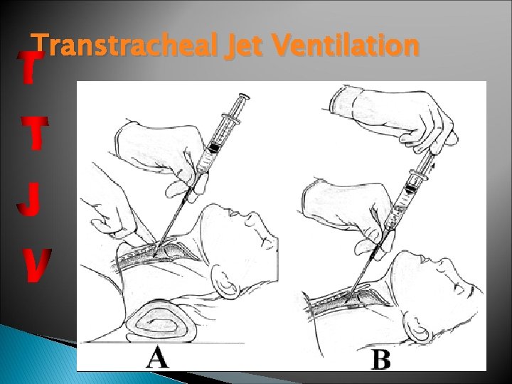 Transtracheal Jet Ventilation Transtracheal Jet Ventilation