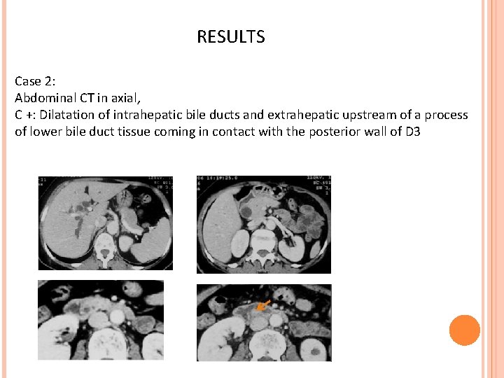 RESULTS Case 2: Abdominal CT in axial, C +: Dilatation of intrahepatic bile ducts