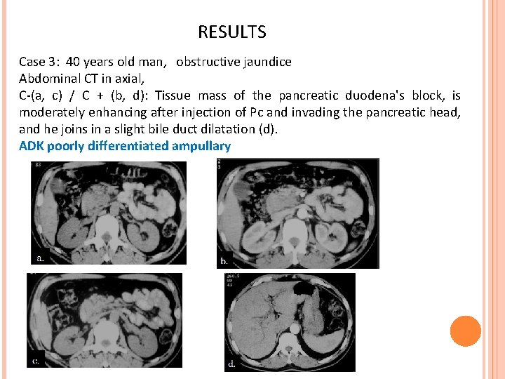 RESULTS Case 3: 40 years old man, obstructive jaundice Abdominal CT in axial, C-(a,