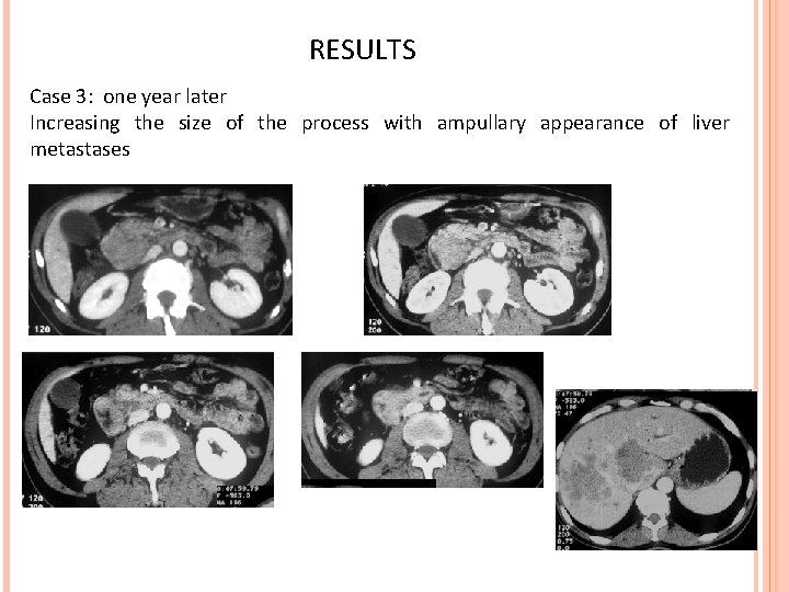 RESULTS Case 3: one year later Increasing the size of the process with ampullary