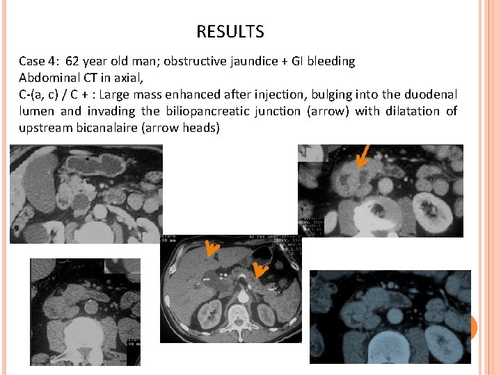 RESULTS Case 4: 62 year old man; obstructive jaundice + GI bleeding Abdominal CT