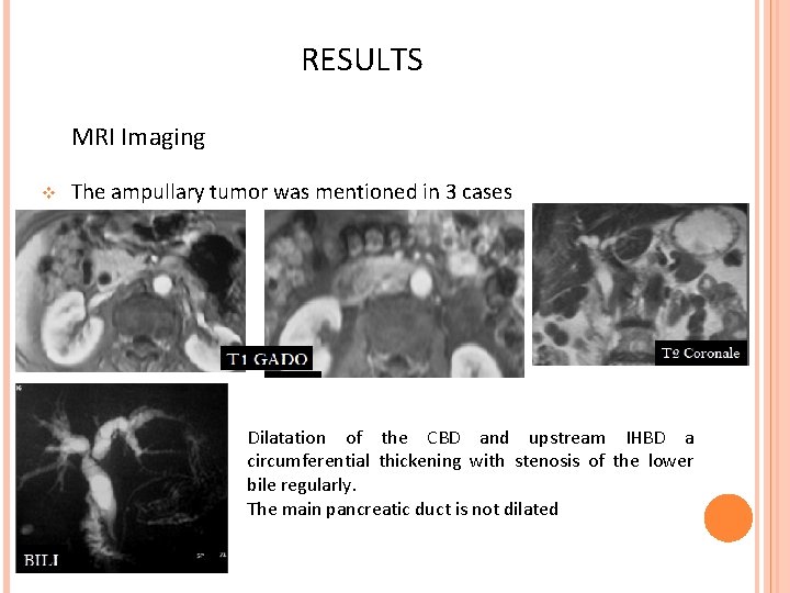 RESULTS MRI Imaging v The ampullary tumor was mentioned in 3 cases Dilatation of