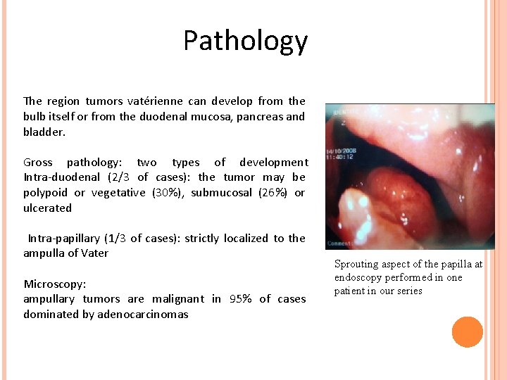 Pathology The region tumors vatérienne can develop from the bulb itself or from the