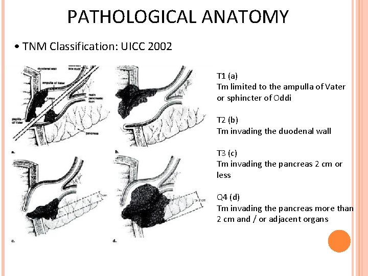 PATHOLOGICAL ANATOMY • TNM Classification: UICC 2002 T 1 (a) Tm limited to the