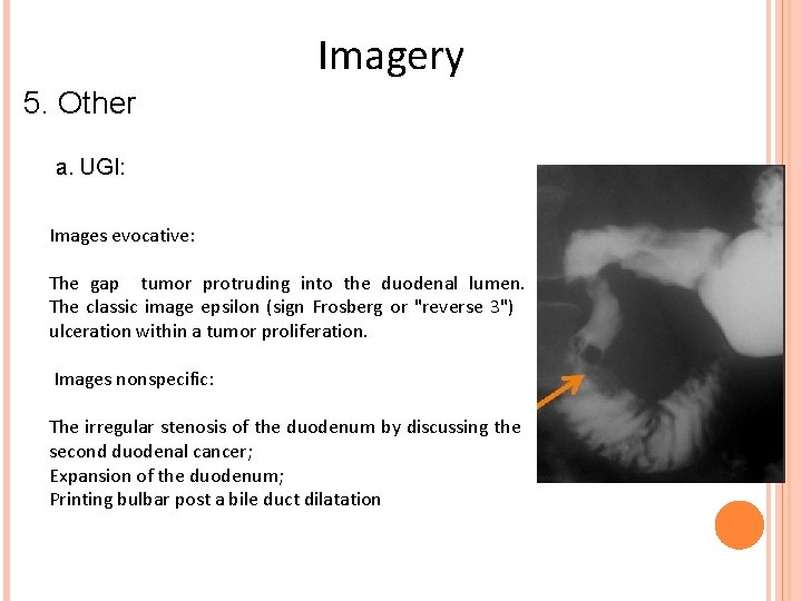 Imagery 5. Other a. UGI: Images evocative: The gap tumor protruding into the duodenal