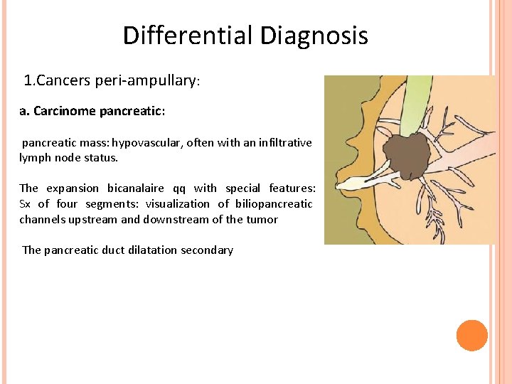 Differential Diagnosis 1. Cancers peri-ampullary: a. Carcinome pancreatic: pancreatic mass: hypovascular, often with an