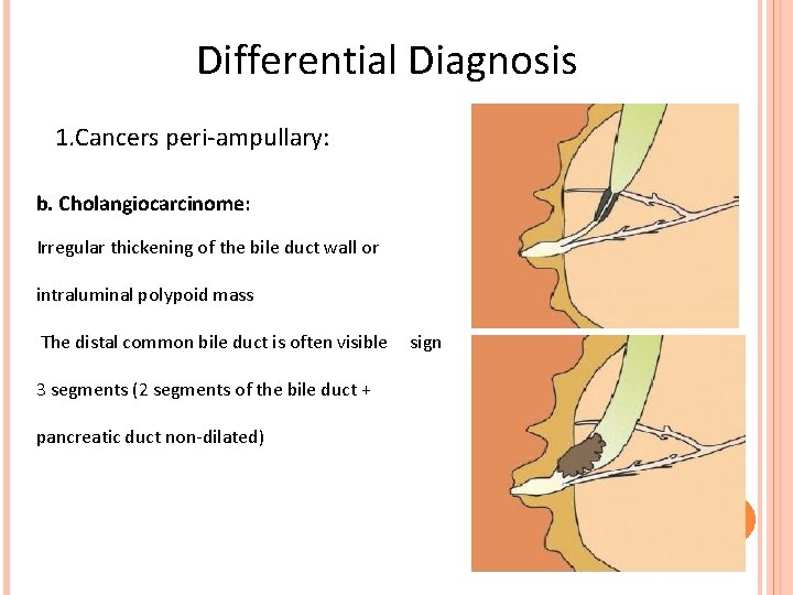 Differential Diagnosis 1. Cancers peri-ampullary: b. Cholangiocarcinome: Irregular thickening of the bile duct wall