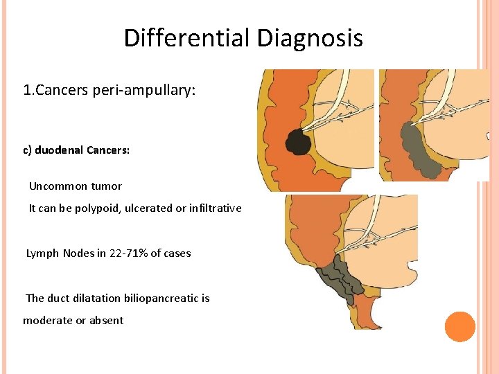 Differential Diagnosis 1. Cancers peri-ampullary: c) duodenal Cancers: Uncommon tumor It can be polypoid,