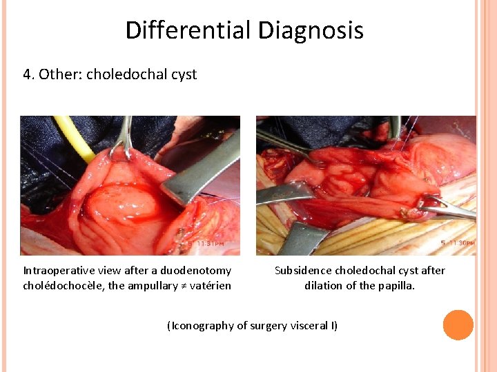Differential Diagnosis 4. Other: choledochal cyst Intraoperative view after a duodenotomy cholédochocèle, the ampullary