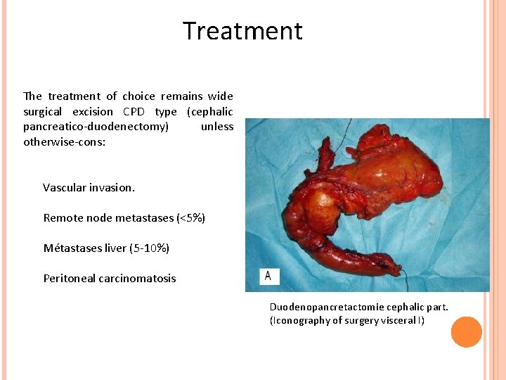 Treatment The treatment of choice remains wide surgical excision CPD type (cephalic pancreatico-duodenectomy) unless