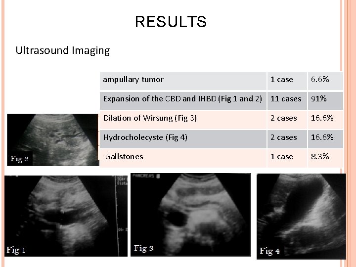 RESULTS Ultrasound Imaging ampullary tumor 1 case 6. 6% Expansion of the CBD and