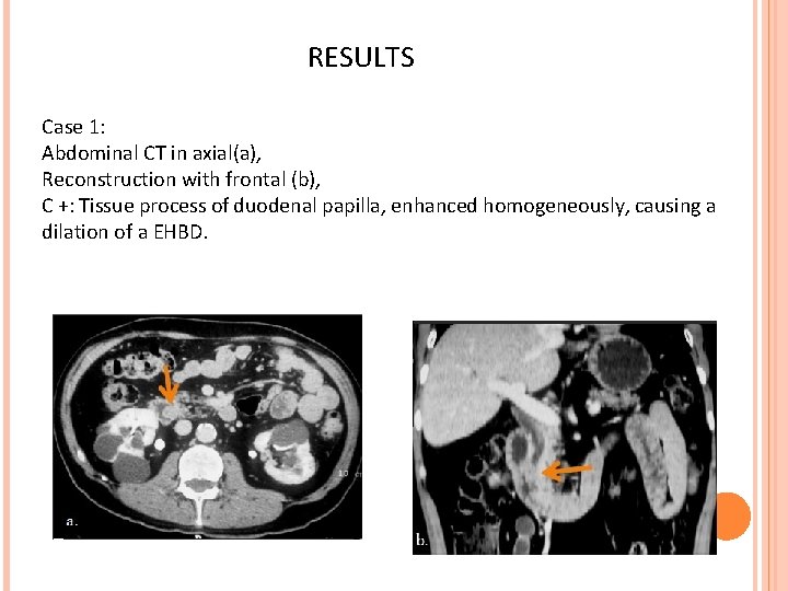 RESULTS Case 1: Abdominal CT in axial(a), Reconstruction with frontal (b), C +: Tissue