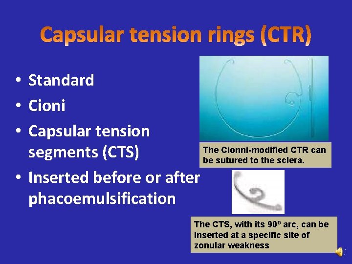  • Standard • Cioni • Capsular tension The Cionni-modified CTR can segments (CTS)