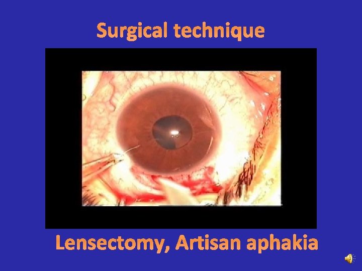 Surgical technique Lensectomy, Artisan aphakia 