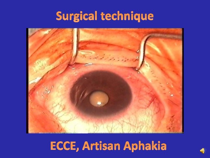 Surgical technique ECCE, Artisan Aphakia 