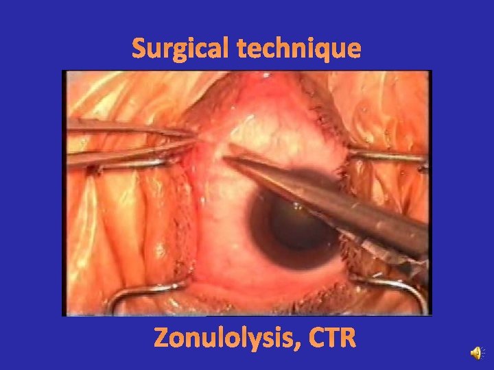Surgical technique Zonulolysis, CTR 