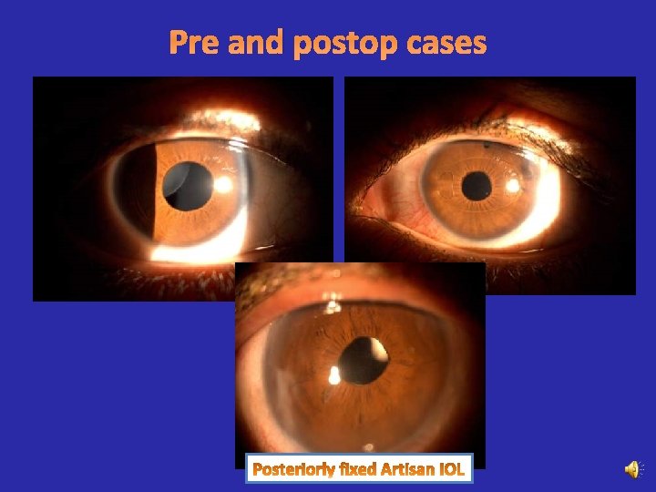 Pre and postop cases 