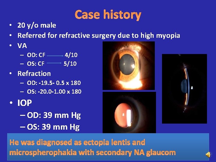 Case history • 20 y/o male • Referred for refractive surgery due to high