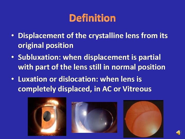 Definition • Displacement of the crystalline lens from its original position • Subluxation: when