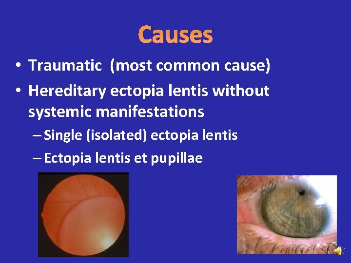 Causes • Traumatic (most common cause) • Hereditary ectopia lentis without systemic manifestations –