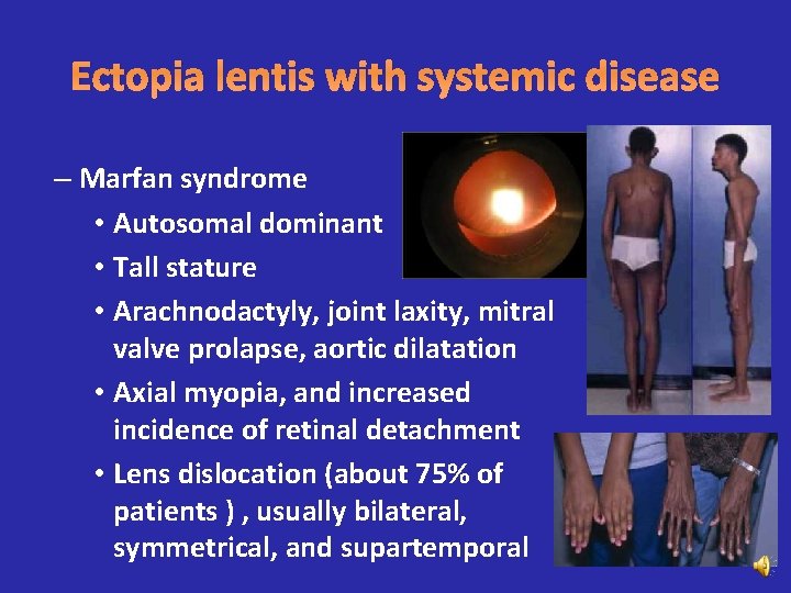 Ectopia lentis with systemic disease – Marfan syndrome • Autosomal dominant • Tall stature