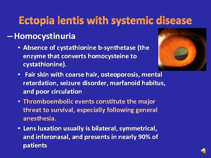 Ectopia lentis with systemic disease – Homocystinuria • Absence of cystathionine b-synthetase (the enzyme