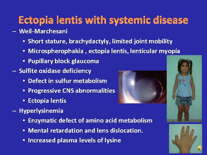 Ectopia lentis with systemic disease – Weil-Marchesani • Short stature, brachydactyly, limited joint mobility