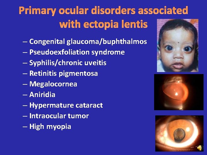 Primary ocular disorders associated with ectopia lentis – Congenital glaucoma/buphthalmos – Pseudoexfoliation syndrome –