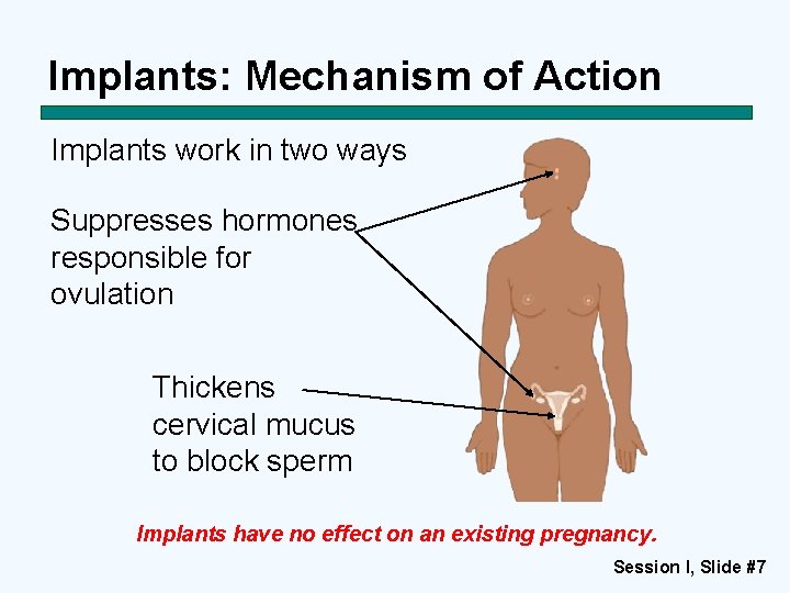 Implants: Mechanism of Action Implants work in two ways Suppresses hormones responsible for ovulation