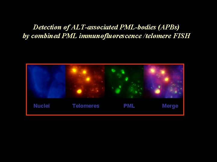 Detection of ALT-associated PML-bodies (APBs) by combined PML immunofluorescence /telomere FISH Nuclei Telomeres PML