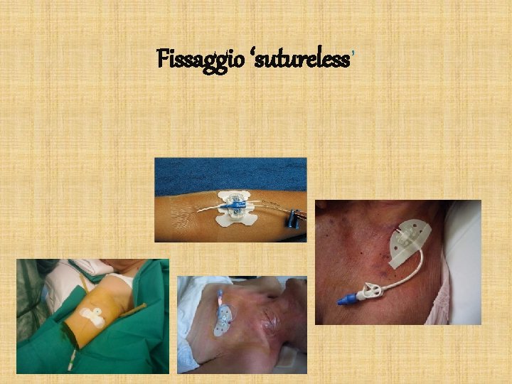 Fissaggio ‘sutureless’ 