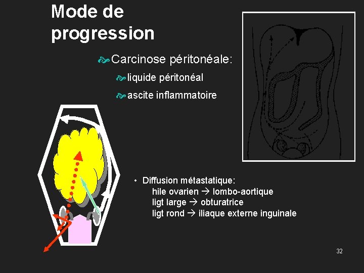 Mode de progression Carcinose péritonéale: liquide péritonéal ascite inflammatoire • Diffusion métastatique: hile ovarien