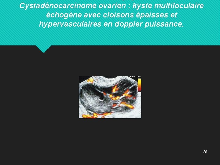 Cystadénocarcinome ovarien : kyste multiloculaire échogène avec cloisons épaisses et hypervasculaires en doppler puissance.