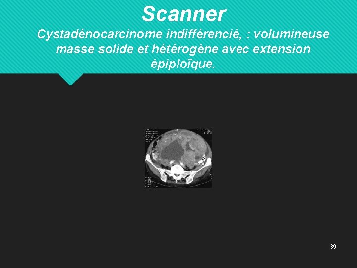 Scanner Cystadénocarcinome indifférencié, : volumineuse masse solide et hétérogène avec extension épiploïque. 39 