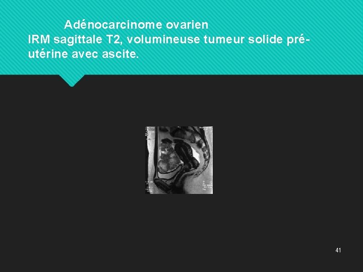 Adénocarcinome ovarien IRM sagittale T 2, volumineuse tumeur solide préutérine avec ascite. 41 