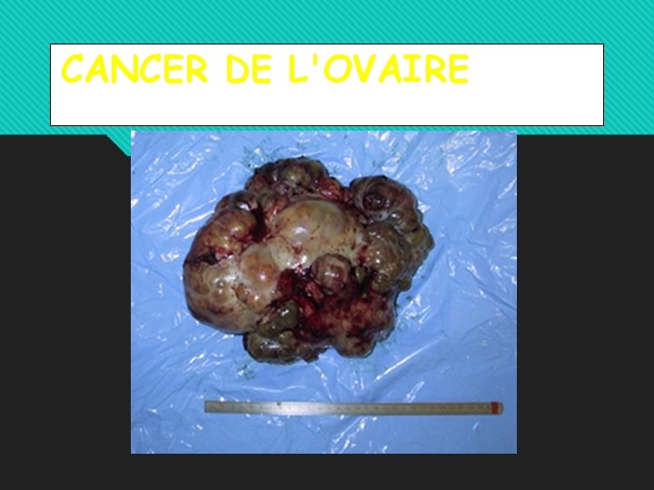 CANCER DE L'OVAIRE 