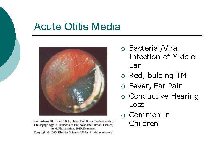 Acute Otitis Media ¡ ¡ ¡ Bacterial/Viral Infection of Middle Ear Red, bulging TM