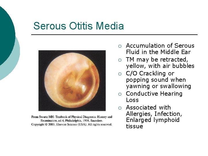 Serous Otitis Media ¡ ¡ ¡ Accumulation of Serous Fluid in the Middle Ear