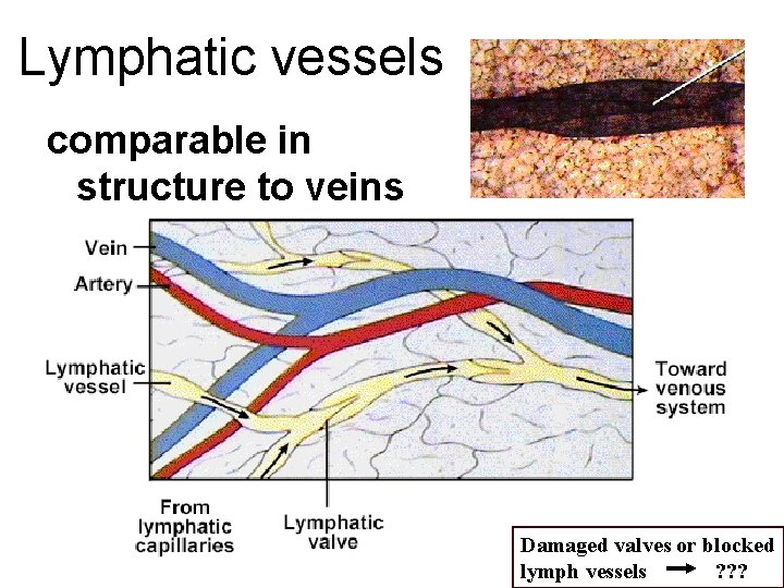 Lymphatic vessels comparable in structure to veins Damaged valves or blocked lymph vessels ?