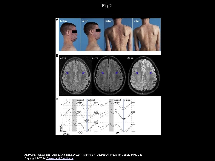 Fig 2 Journal of Allergy and Clinical Immunology 2014 1331400 -1409. e 5 DOI: