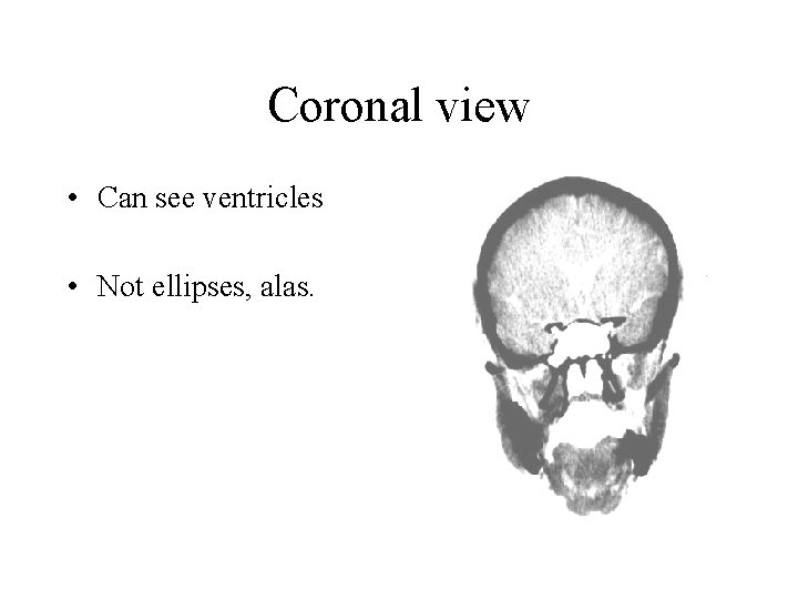 Coronal view • Can see ventricles • Not ellipses, alas. 